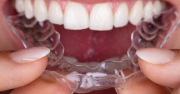 A close up of a female placing an Invisalign tray into her mouth