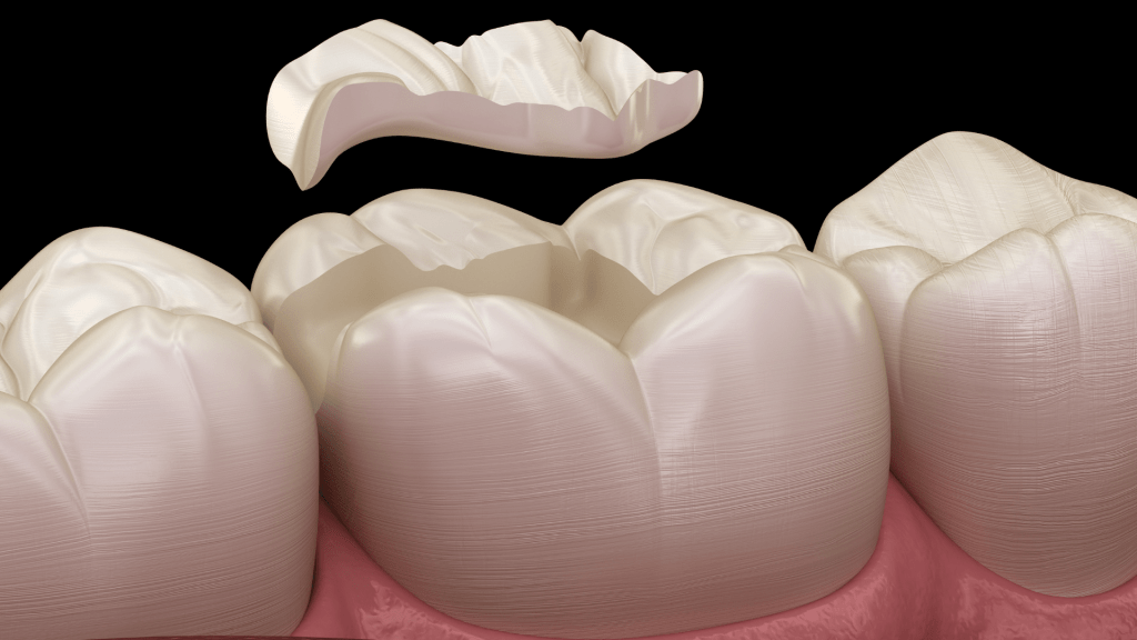 Illustration of a dental onlay being placed on a molar tooth. The crown hovers above the prepared tooth, showing a realistic texture and enamel color.